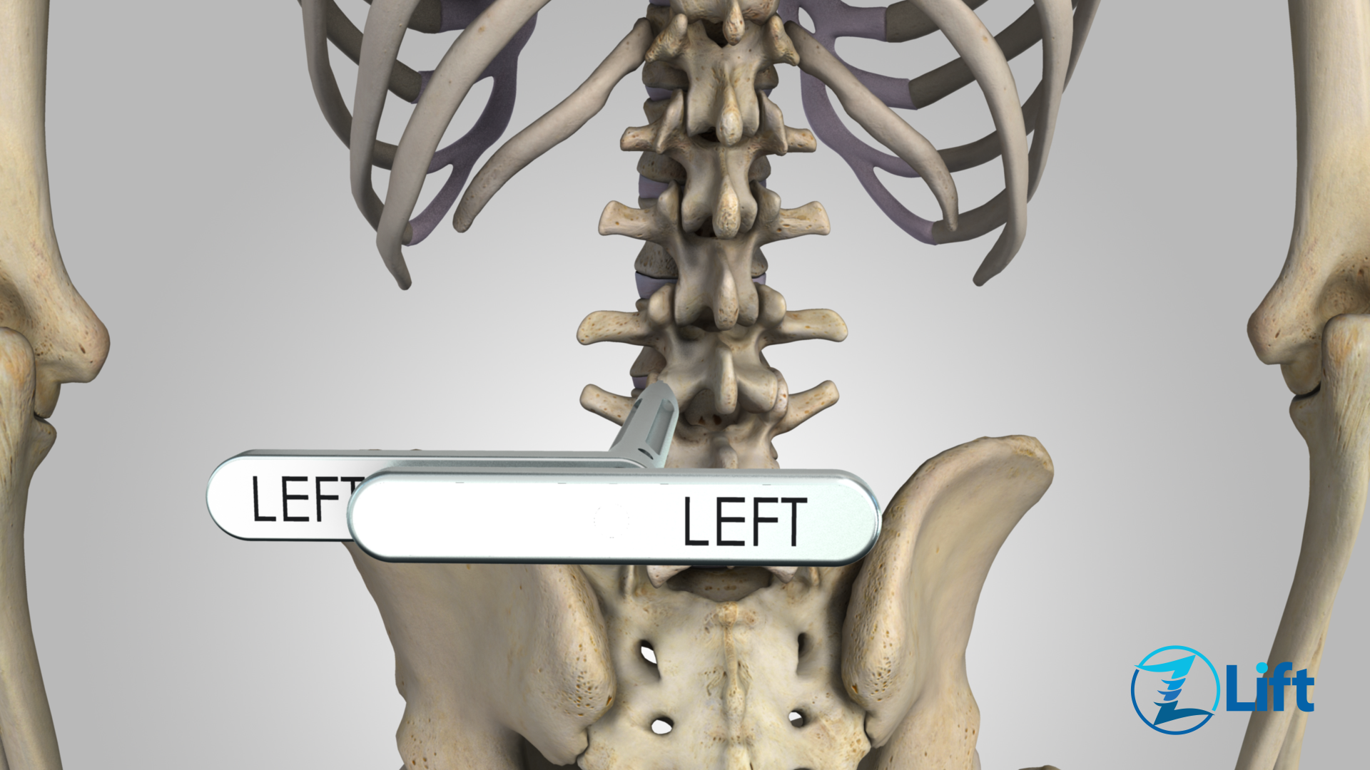 Disc Herniation