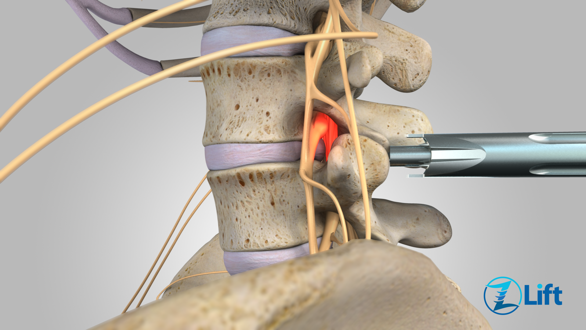 Spinal Stenosis