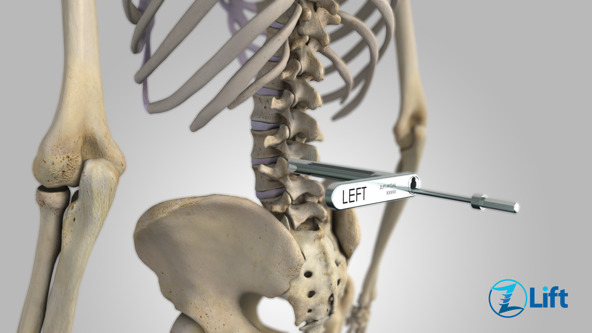 Spondylolisthesis